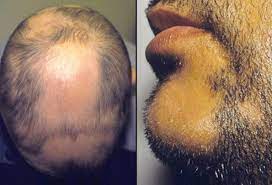 Physical hair damage or defect (eg, trichotillomania, loose anagen syndrome, monilethrix, and overprocessing) androgenetic alopecia is by far the most common form of hair loss, followed by telogen. Alopecia Areata Picture Image On Medicinenet Com