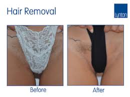 That means you will save big in the long term since you'll no longer be paying for waxing, razors, or shaving gel. Laser Hair Removal Professional Treatment The Lynton Clinic
