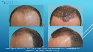 Few months after the surgery, can i tonsure (shave) my head? Fue Wear Your Hair Short After Hair Transplant Case Study Sara Wasserbauer Md