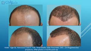 The growth phase is called anagen and 90% of our hair follicles are in this phase at any given time. Fue Wear Your Hair Short After Hair Transplant Case Study Sara Wasserbauer Md
