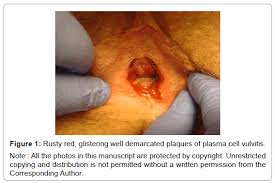 Image result for Vulvitis