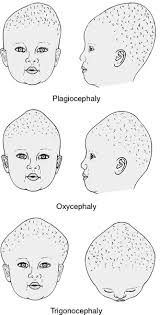 Image result for Craniotabes
