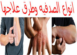 الصدفيه علاج الصدفيه امراض جلديه علاج الصدفية نهائيا مرض الصدفيه الحياه الصحيه Healthy Life