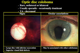 Image result for Coloboma