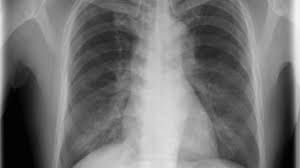 Tobacco smoke contains many chemicals that are. Ex Smoker S Ct Scan Reveals Rare Lung Cancer Mimicking Asthma
