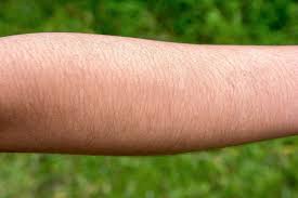 This is a condition that causes unwanted hair in females, and is characterized by thick, coarse black hair in areas where such hair usually appears on men. Hirsutism Familydoctor Org