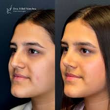 La rinoplastia no solo cambia la apariencia, también mejora funciones  esenciales como la respiración y el descanso. Pequeños ajustes pueden  marcar una gran diferencia en la vida de una persona. Te compartimos