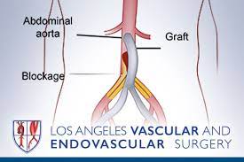 Aortoiliac Occlusive Disease Conditions And Treatments La Vascular Endovascular Surgery