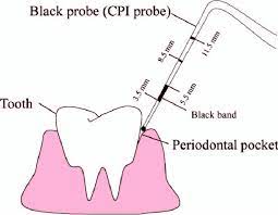 Check spelling or type a new query. Dental Cpi Probe Used For Measuring Periodontal Pocket Depths Cpi Download Scientific Diagram