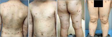Seven Weeks After Initiation Of Treatment With Methotrexate Download Scientific Diagram