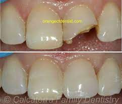 Dental Tooth Bonding Cosmetic Dentist Orange Woodbridge Milford Ct Fix Teeth Tooth Repair Broken Tooth Repair