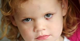 Plymouth toddler bitten by Staffordshire bull terrier dog