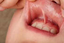 Frenillo Labial Y Dientes Separados Cuando Hay Que Tratarlo Clinica Smile