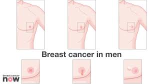 In fact, like many men, i didn't even know we were. Breast Cancer Now On Twitter Roy It Was My Wife Who Spotted That My Nipple Was Looking Odd Around 80 Men Die From Breast Cancer In The Uk Every Year If