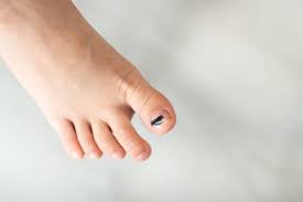 Comment soigner un ongle incarné ou un panaris ? Ongle Jaune Bleu Fissure Que Signifient Ces Symptomes