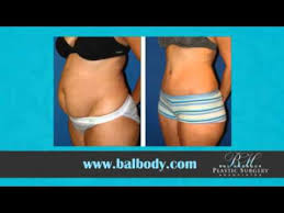 A tummy tuck involves removing loose skin and tightening muscles around the abdomen area. Tummy Tuck Miami Abdominoplasty Miami Dr Miami