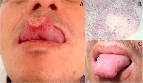 In humans it is caused mainly by the bacterium mycobacterium tuberculosis. Lingual Tuberculosis In An Hiv Aids Patient International Journal Of Infectious Diseases