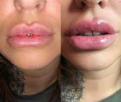 Dos and don'ts after having cosmetic fillers. Hii Pen Needle Free Lip Plumper In You Beauty