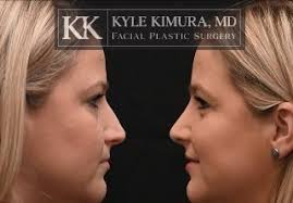 I'm really happy with how my nose looks now!