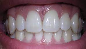 8 Tips To Protect Your Tooth Enamel Dentista Italiano A Londra