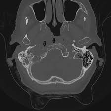 Image result for Necrotizing Otitis Externa