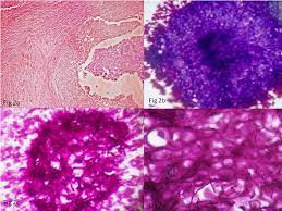 A rare pathology in morocco (about 15 cases) messoudi a, fnini s, el andaloussi y, charafeddine a, marouane s, ouarab m, largab a. Histological Features Of Eumycetoma Download Scientific Diagram
