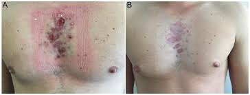 Acne vulgaris acneiform eruptions skin diseases. Isotretinoin Induced Acne Fulminans Without Systemic Symptoms Treated Successfully With Oral Dapsone Html Acta Dermato Venereologica