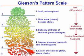 Being armed with information is vital to begin the fight. Prostate Cancer Gleason Score