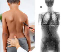 ما هي أنواع اعوجاج العمود الفقري؟ Scoliosis -