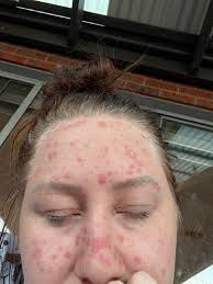 Psoriasis