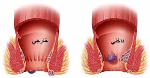 البواسير أنواعها أسبابها أعراضها و علاجها في البيت