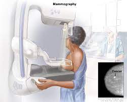 A biopsy is a procedure in which the doctor removes a sample of tissue. Breast Cancer Screening Pdq Patient Version National Cancer Institute