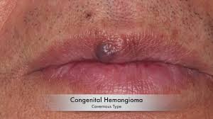 While cherry angioma home remedies may not completely remove a cherry angioma, they may help shrink them. Laser Hemangioma Removal Youtube
