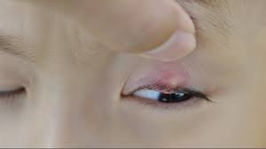 Gejala utama pada bisul adalah munculnya benjolan merah pada kulit. 3 Alasan Kenapa Penderita Diabetes Sering Bisulan