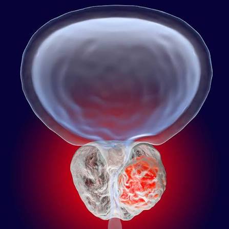 prostate cancer symptoms