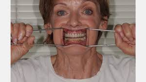 Communicating a Facebow Transfer Procedure: A Case Study