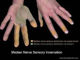 Carpal Tunnel Syndrome