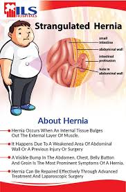 Hernia Does Not Produce Any Immediate Threat But It Can Lead To Several Complications If Left Untreated Address Hernia Effective Abdominal Prevention Muscle
