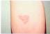 Back Herpes Gladiatorum
