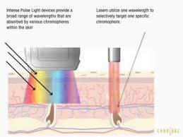 How does ipl hair removal work? Ipl Hair Removal Vs Laser Hair Removal Which Is Better Youtube