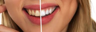 Maybe you would like to learn more about one of these? 4 Foods To Avoid After You Ve Gotten Your Teeth Whitened Dentrix Dentalcare