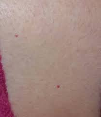 Derideki Kucuk Kirmizi Noktalar Kadinlar Kulubu