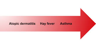 Image result for Allergic Triad