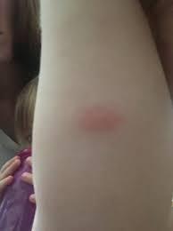 It is caused by allergenic polypeptides in mosquito saliva, and therefore is not contagious. Does Anyone S Child Have Skeeter Syndrome Babycenter