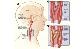 We did not find results for: Carotid Artery Disease Stenosis Symptoms And Treatments Healthy Living Articles Well Being Center Steadyhealth Com