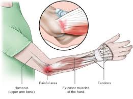 Lateral epicondylitis, also known as tennis elbow, is an overuse syndrome of the common extensor tendon and predominantly epidemiology lateral epicondylitis occurs with a frequency seven. Epicondylitis Humeri Radialis Med Kom