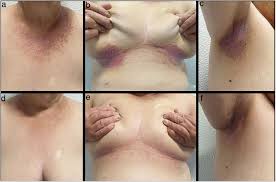 Dos casos de enfermedad de Darier eficazmente tratados con una combinación  de retinoides orales y gel de diclofenaco sódico al 3% | Actas  Dermo-Sifiliográficas