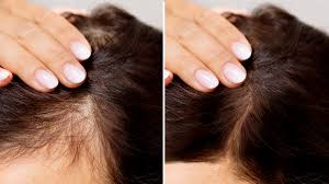 The Best Hair Loss Treatments and Medications - GoodRx