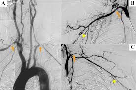 Image result for Jaw Claudication