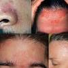 Yeast infection of the skin (cutaneous candidiasis). 1